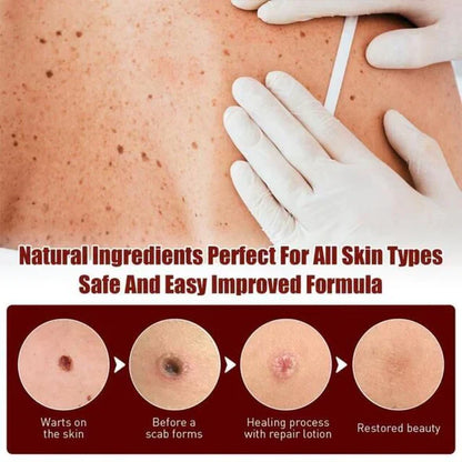 🔥Histone™ Tags & Moles Remover（🔥LAST DAY SALE-85% OFF🔥)