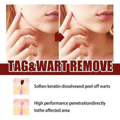 🔥Histone™ Tags & Moles Remover（🔥LAST DAY SALE-85% OFF🔥)