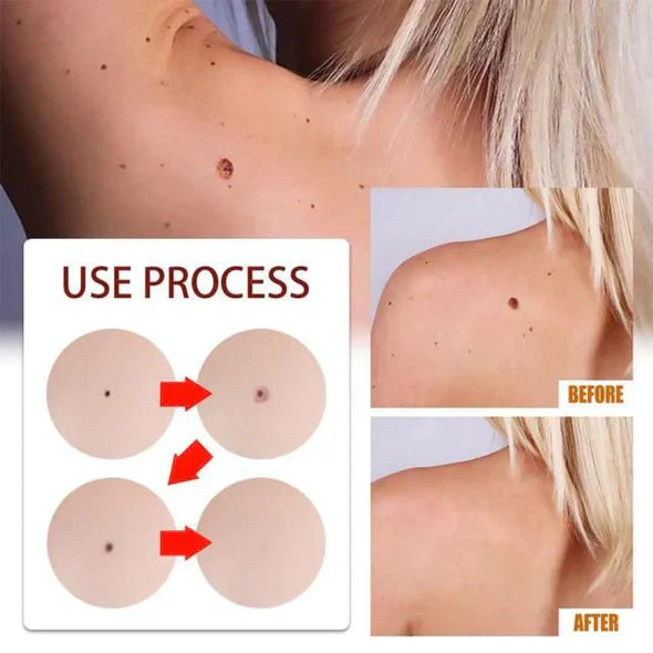 🔥Histone™ Tags & Moles Remover（🔥LAST DAY SALE-85% OFF🔥)