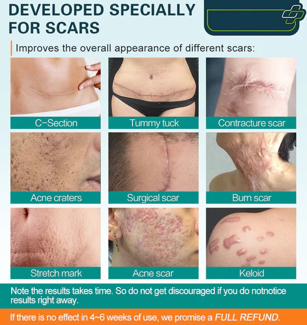 (🔥Last Day Sale-85% OFF🔥)❤️Advanced Scar Spray For All Types of Scars - For example Acne Scars, Surgical Scars and Stretch Marks