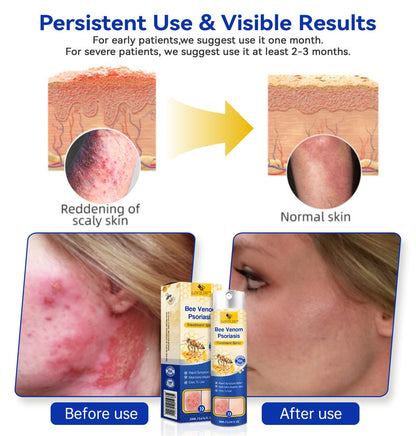 (🔥Last Day Sale-85% OFF🔥) LOVILDS™PsoriaHeal psoriasis Spray pro🔥Global shipping