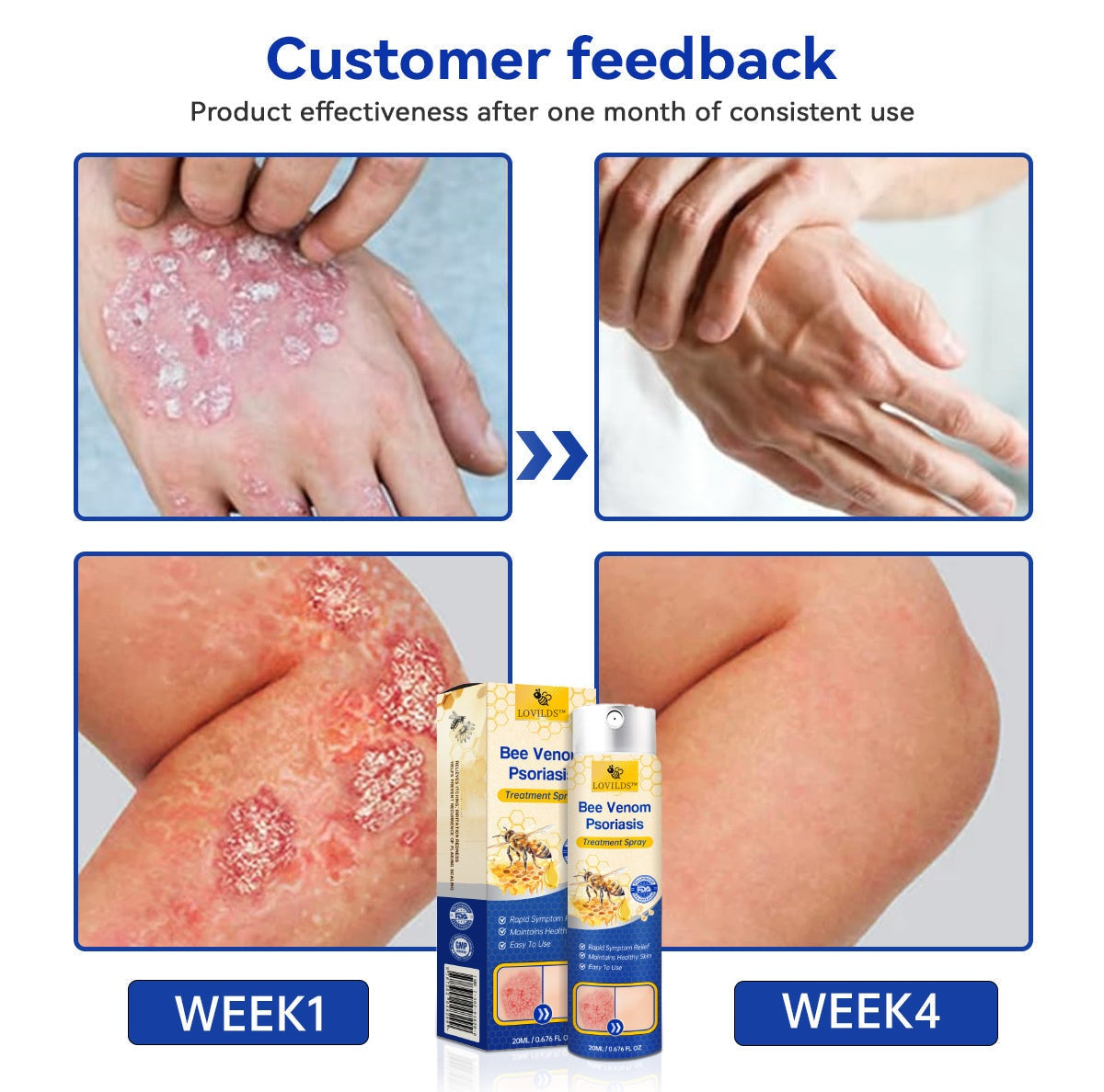 (🔥Last Day Sale-85% OFF🔥) LOVILDS™PsoriaHeal psoriasis Spray pro🔥Global shipping