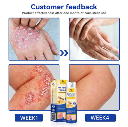 (🔥Last Day Sale-85% OFF🔥) LOVILDS™PsoriaHeal psoriasis Spray pro🔥Global shipping