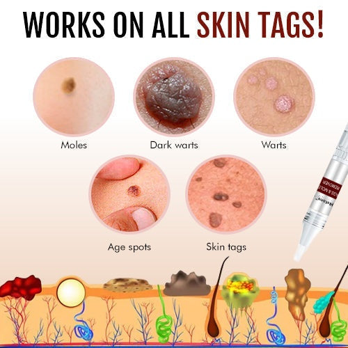 🔥Histone™ Tags & Moles Remover（🔥LAST DAY SALE-85% OFF🔥)